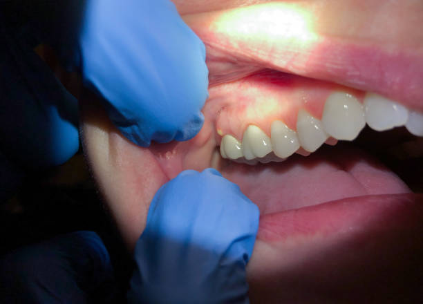 Best Emergency Care for Gum Disease in Orleans, VT